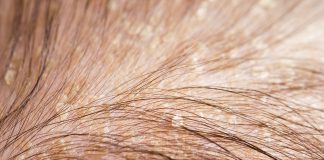 Dermite Séborrhéique : Symptômes et Traitements Cuir chevelu avec pellicules et squames, symptôme de dermite séborrhéique, nécessitant traitements spécifiques.