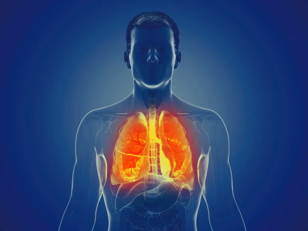 Représentation 3D des poumons affectés par la mucoviscidose (fibrose kystique), montrant l'inflammation des voies respiratoires