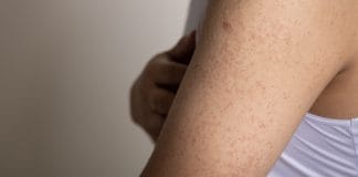 Kératose Pilaire : Causes, Symptômes et Traitement Vue d'un bras présentant des petites bosses rougeâtres réparties uniformément sur la peau. Les bosses sont de petite taille et apparaissent comme des points rouges légers sur la surface de la peau.