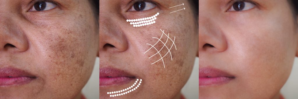 Progression du mélasma : taches brunes sur le visage avant, pendant et après traitement, masque de grossesse visible.