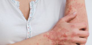 Psoriasis : Qu’est-ce que c’est, symptômes, causes, types et traitements Gros plan sur le bras d'une personne atteinte de psoriasis, montrant des plaques rouges, squameuses et inflammées caractéristiques de la maladie sur la peau. La personne porte un haut blanc avec une bordure décorative bleue et rose. L'image illustre clairement les symptômes visibles du psoriasis sur l'avant-bras et le poignet.