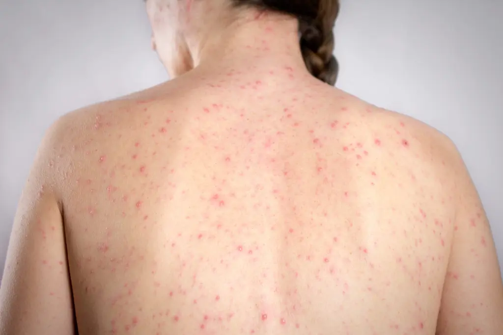 Vue du dos d'une personne atteinte de rougeole, montrant une éruption cutanée typique avec des taches rouges disséminées sur toute la surface de la peau