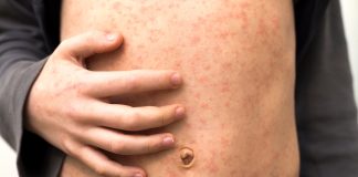 Rougeole : Causes, Symptômes, Diagnostic et Traitement Éruption cutanée caractéristique de la rougeole sur l'abdomen d'un patient, montrant des taches rouges plates et confluentes avec une main indiquant la zone touchée