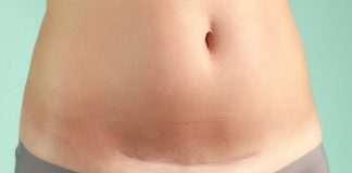 Cicatrice de césarienne : types, soins et traitements pour une cicatrisation rapide Abdomen montrant une cicatrice horizontale de césarienne type bikini partiellement cicatrisée, visible au-dessus d'un sous-vêtement