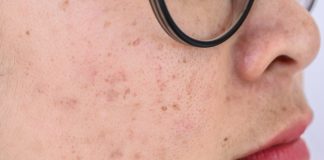 Mélasma (masque de grossesse) Visage avec taches brunes du mélasma, masque de grossesse visible près des lunettes.