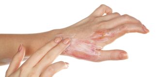 Brûlures : Symptômes, Types, Traitements et Récupération Application d'une crème apaisante sur une brûlure superficielle de la main. Traitement d'une lésion cutanée par brûlure thermique avec une pommade médicale.