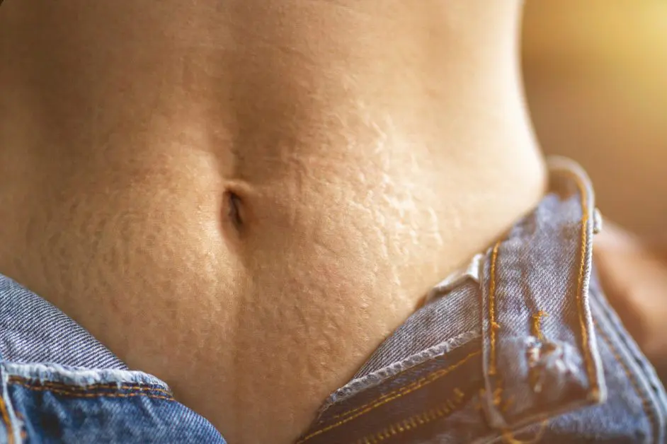 Abdomen d’une femme montrant des vergetures, avec un jean légèrement descendu