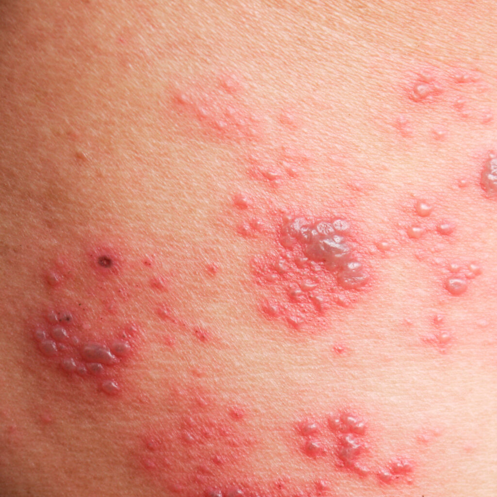 Photo d’une éruption cutanée due au zona sur la peau, montrant des cloques rouges et des zones irritées, illustrant les symptômes typiques de cette infection virale douloureuse.