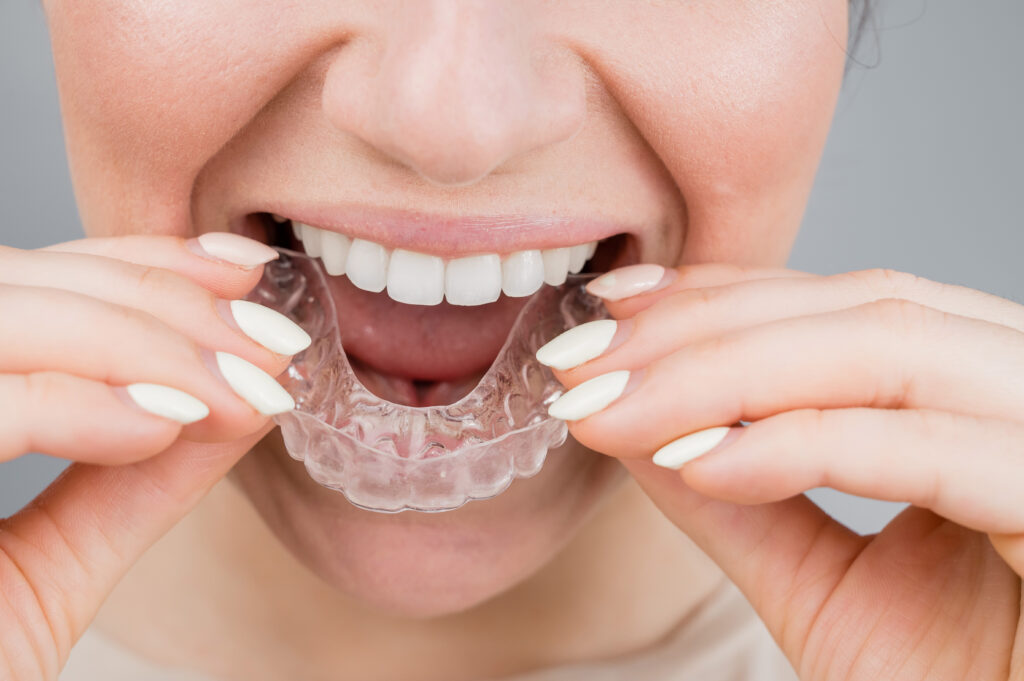 Photo de mains présentant un aligneur transparent devant une bouche souriante, illustrant l’utilisation des aligneurs en orthodontie pour redresser les dents de manière discrète.