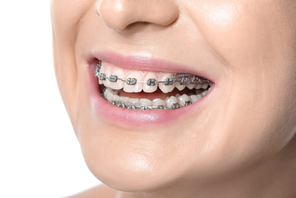 Image d’un sourire montrant un appareil dentaire métallique traditionnel, mettant en évidence une option courante de traitement orthodontique pour aligner les dents.