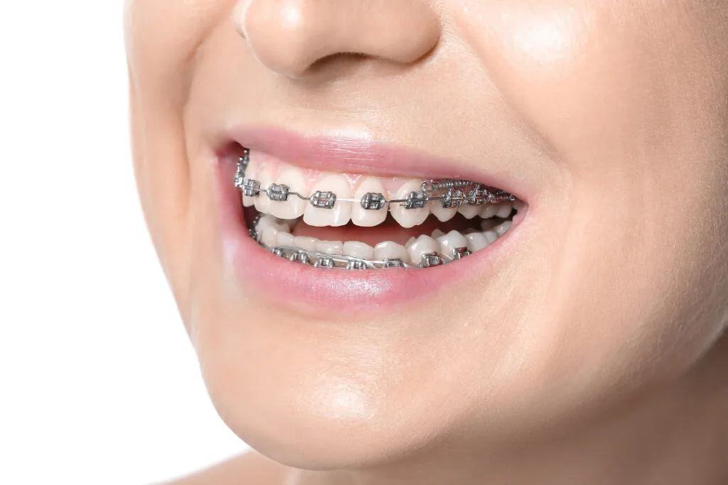 Image d’un sourire montrant un appareil dentaire métallique traditionnel, mettant en évidence une option courante de traitement orthodontique pour aligner les dents.