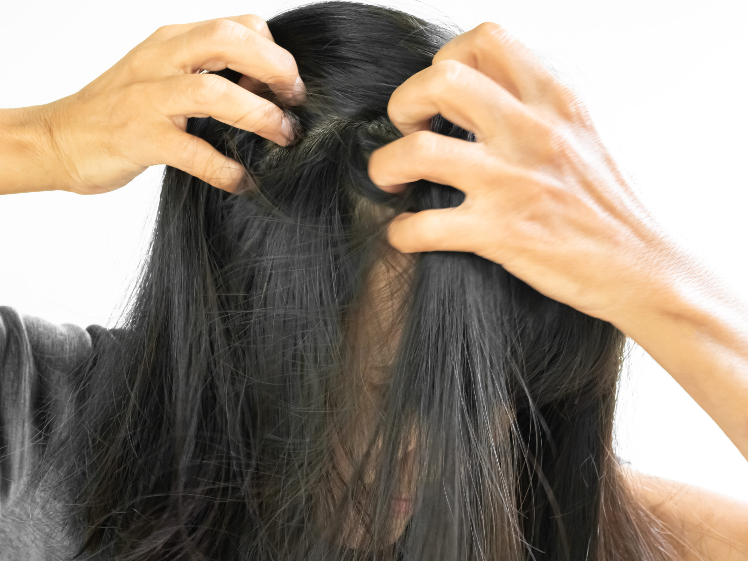 9 Remèdes Maison pour les Démangeaisons du Cuir Chevelu Image d’une femme aux cheveux longs se grattant le cuir chevelu avec les deux mains, illustrant les démangeaisons et l’inconfort liés au prurit du cuir chevelu.